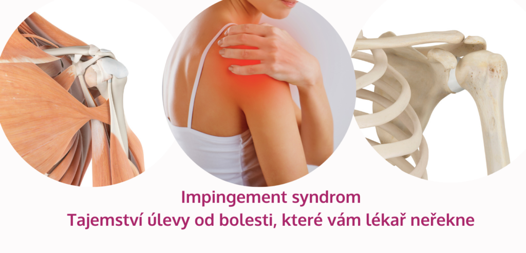 Impingement syndrom: Tajemství úlevy od bolesti, které vám lékař neřekne - martinafallerova.cz